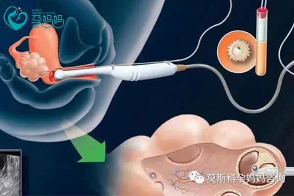 取卵手术疼不疼?怎么才能不疼?