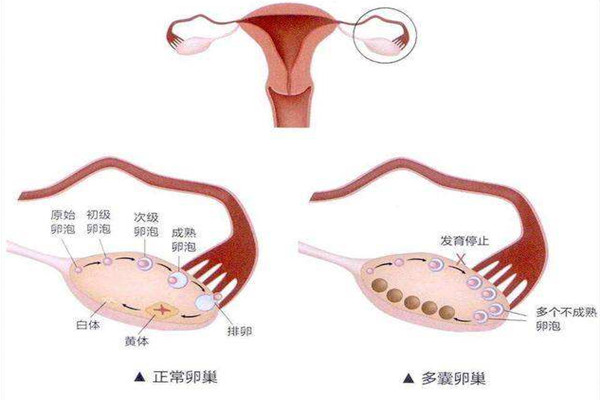 多囊卵巢综合征可以做试管婴儿吗?