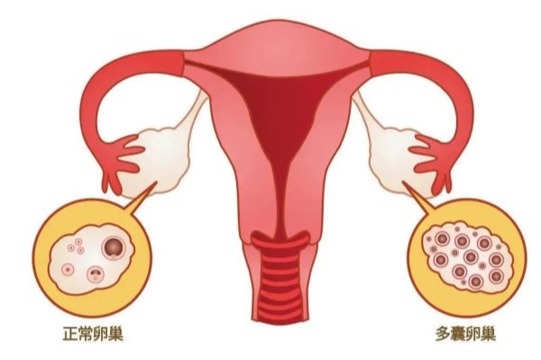 多囊卵巢患者如何科学保养，助力试管婴儿成功之路