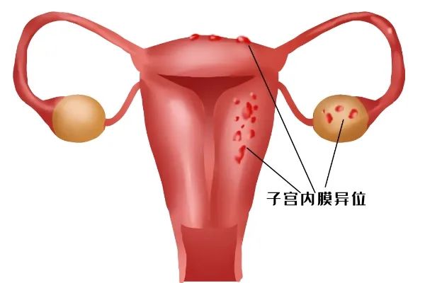 子宫内膜异位症患者的试管之路：希望与挑战并存