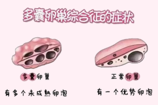 多囊卵巢综合征：备孕路上的“隐形绊脚石”