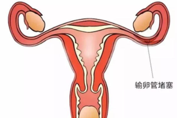 输卵管堵了：手术还是直接试管？选错后悔也来不及！